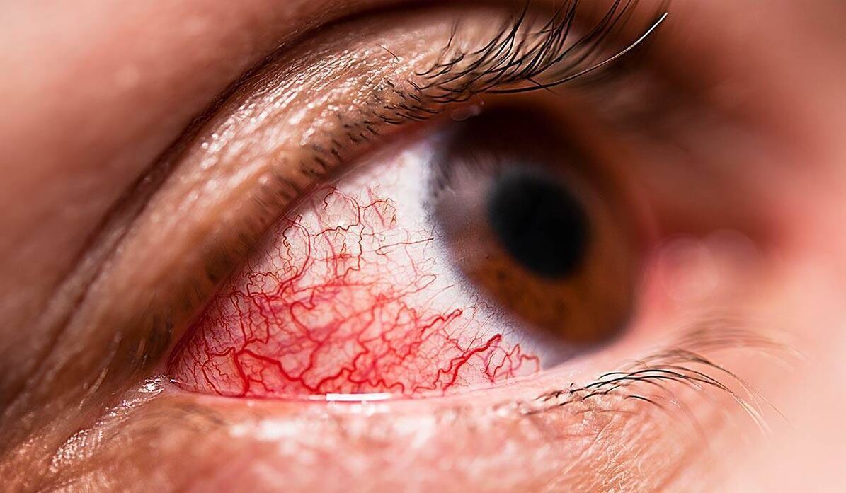Erretinopatia diabetikoa diabetinen konplikazio berantiarretakoa da